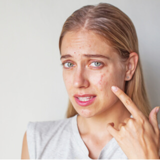 4. حب الشباب