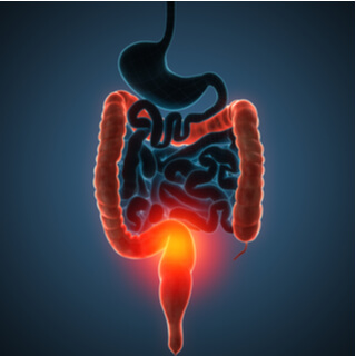 1. أنواع التهاب القولون التقرحي