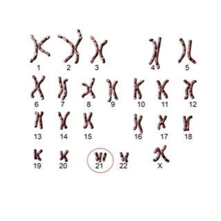 أسباب متلازمة داون