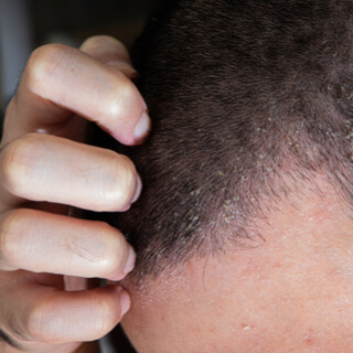 أعراض أكزيما الشعر