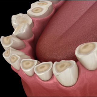 4. تآكل الأسنان