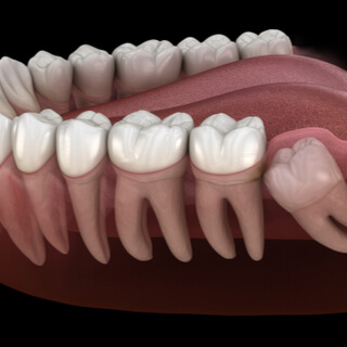 6. انحشار الأسنان