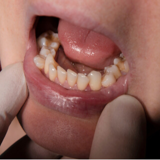 8. نمو الأسنان فوق بعضها