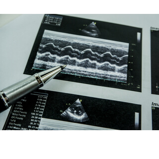 ما بعد تخطيط القلب