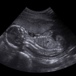 2. الثلث الثاني من الحمل (Second Trimester) 2. الثلث الثاني من الحمل (Second Trimester)