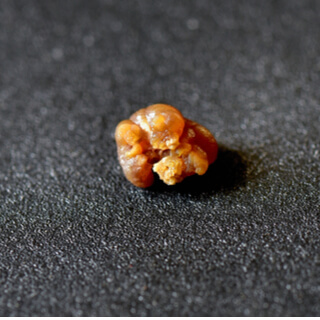 2. حصوات ستروفايت