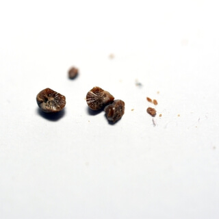 3. حصوات حمض اليوريك