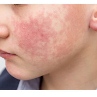 4. متلازمة الخد الصفعية