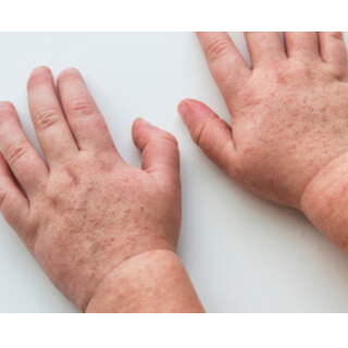 6. الحمى القرمزية