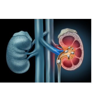 8. علاج حصوات الكلى وتقليل خطر الإصابة بها 8. علاج حصوات الكلى وتقليل خطر الإصابة بها