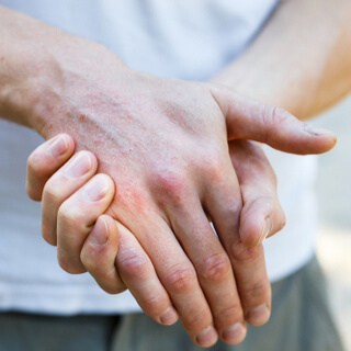 جفاف الجلد بالصور 