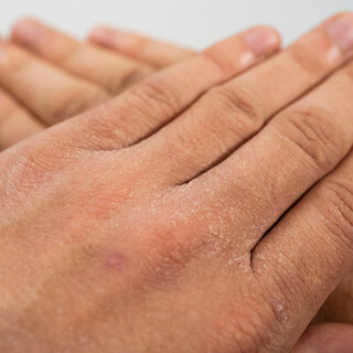 أعراض جفاف الجلد