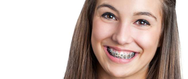 مراحل تقويم الأسنان: أهم المعلومات