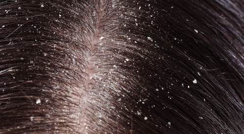 مراهق منطقة كل عام  علاج قشرة الشعر: أهم المعلومات - ويب طب