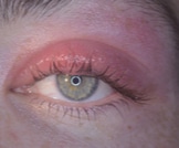 التهاب جفن العين