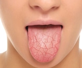 جفاف الفم: أهم المعلومات