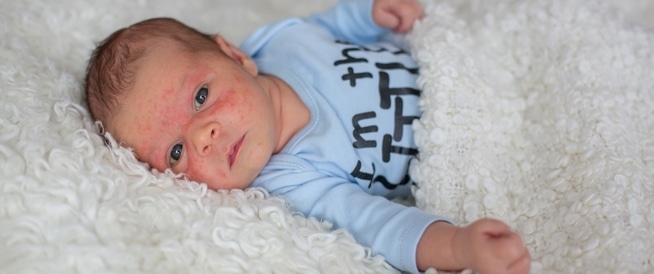 أنواع الطفح الجلدي لدى الرضع: إليك قائمة بأهمها
