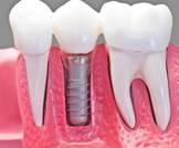 أهم الشروط لنجاح زراعة الأسنان