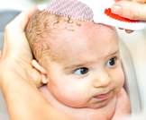 قبعة المهد عند الرضيع: ما تود معرفته