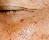 علاج التصبغات الجلدية: تعرف على أهمها