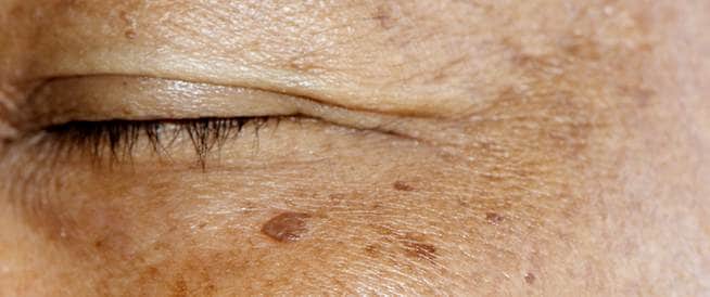 علاج التصبغات الجلدية: تعرف على أهمها