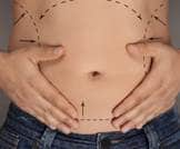 عملية شفط الدهون: دليلك الشامل لمعرفتها