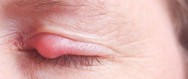 6 وصفات طبيعية للتخلص من شحاذ العين
