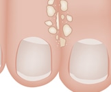 علاج عين السمكة في القدم تعرف عليه ويب طب