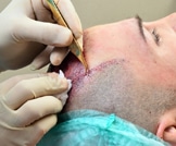 تقنية فعالة لزراعة الشعر دون حلاقة