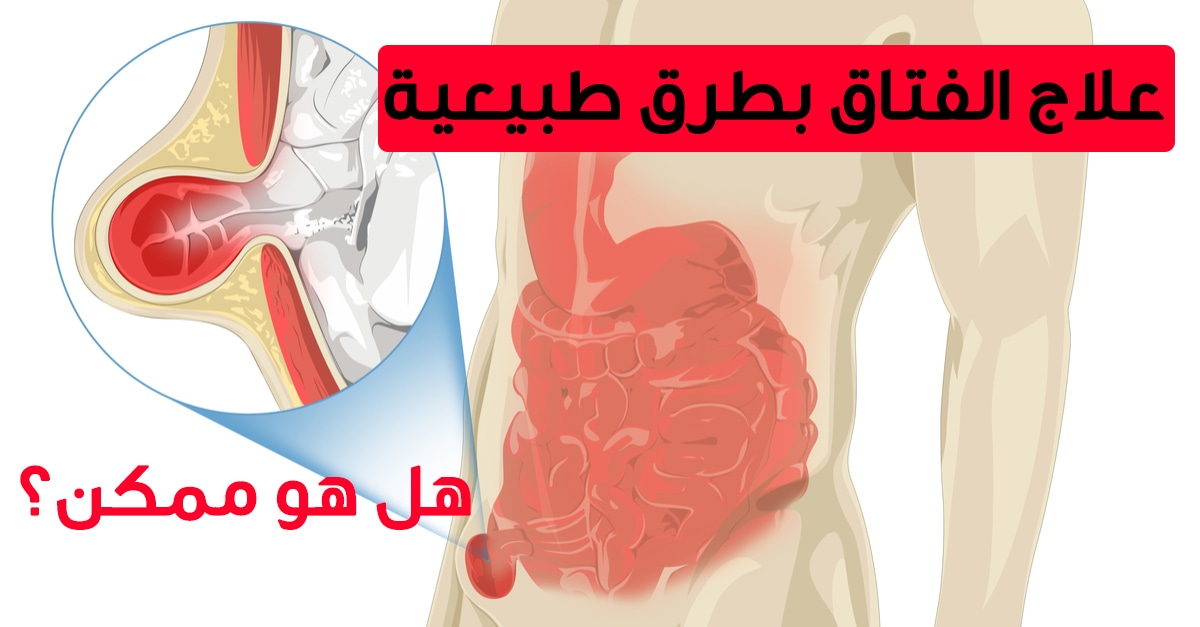 علاج الفتاق بطرق طبيعية هل هو ممكن ويب طب