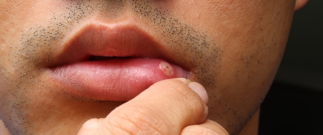 5 حقائق هامة عن سرطان الفم