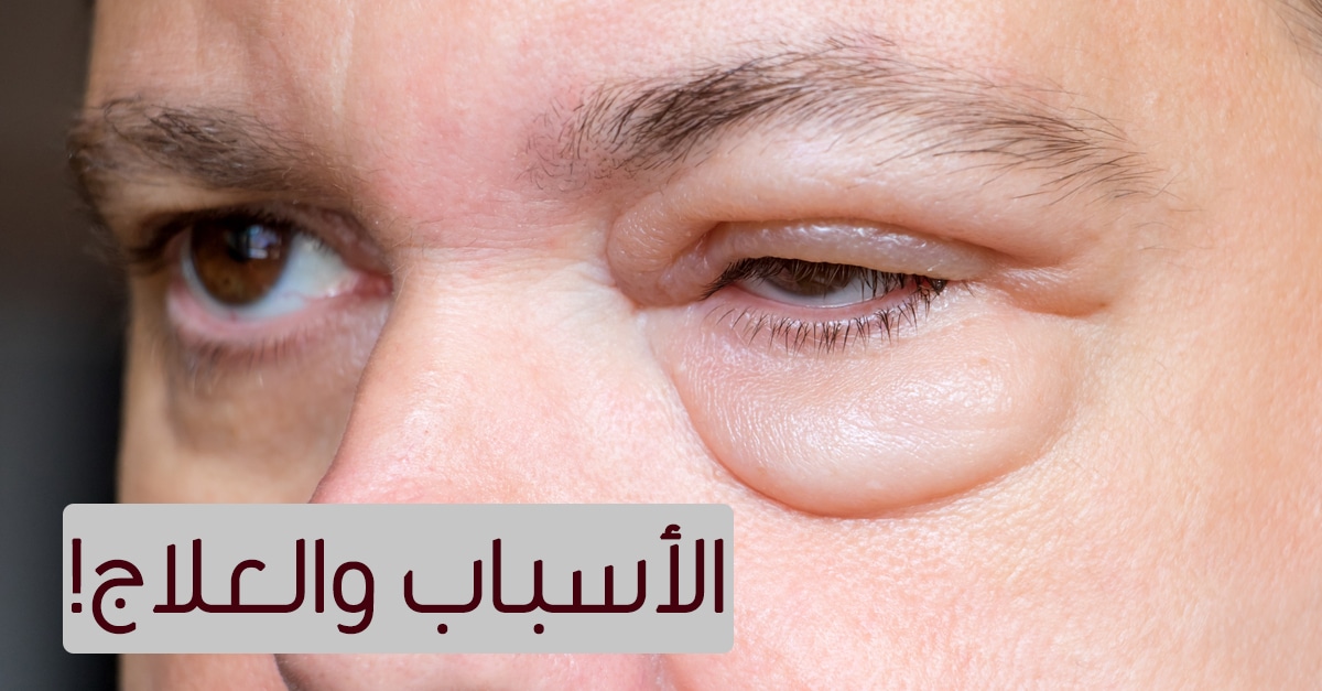 تاثير ارتفاع ضغط الدم على العين