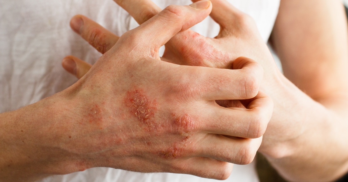 أكزيما اليد: الأعراض والعلاج - ويب طب