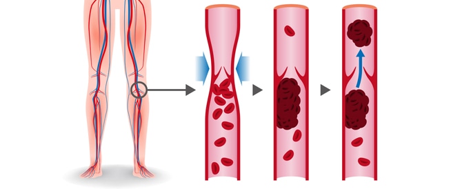 خثار الأوردة العميقة: الدليل الكامل