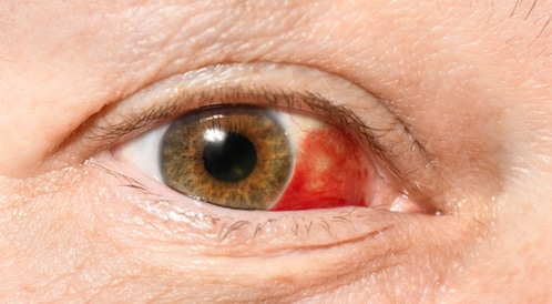 العيون تظهر صور سبب هو الاشخاص في التي الحمراء سبب العيون