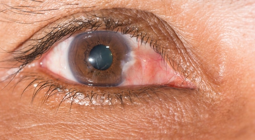 ظفر العين حالة شائعة ولكن هل هي خطيرة ويب طب