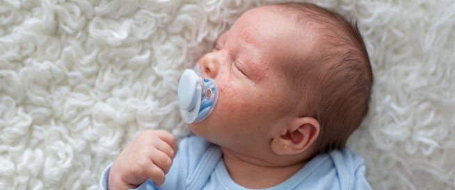 حبوب الجلد عند الرضع: دليلك الشامل لتعرف عليها