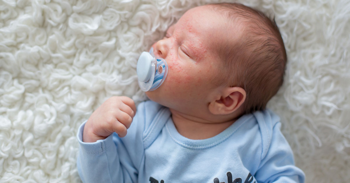 حبوب الجلد عند الرضع دليلك الشامل لتعرف عليها ويب طب