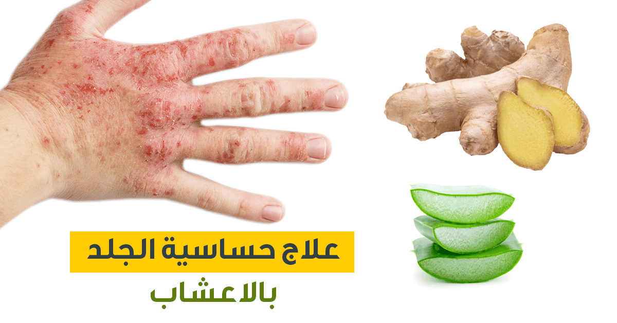 علاج حساسية الجلد بالاعشاب ويب طب