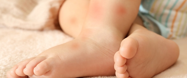 حساسية الجلد عند الأطفال: كل ما تود معرفته