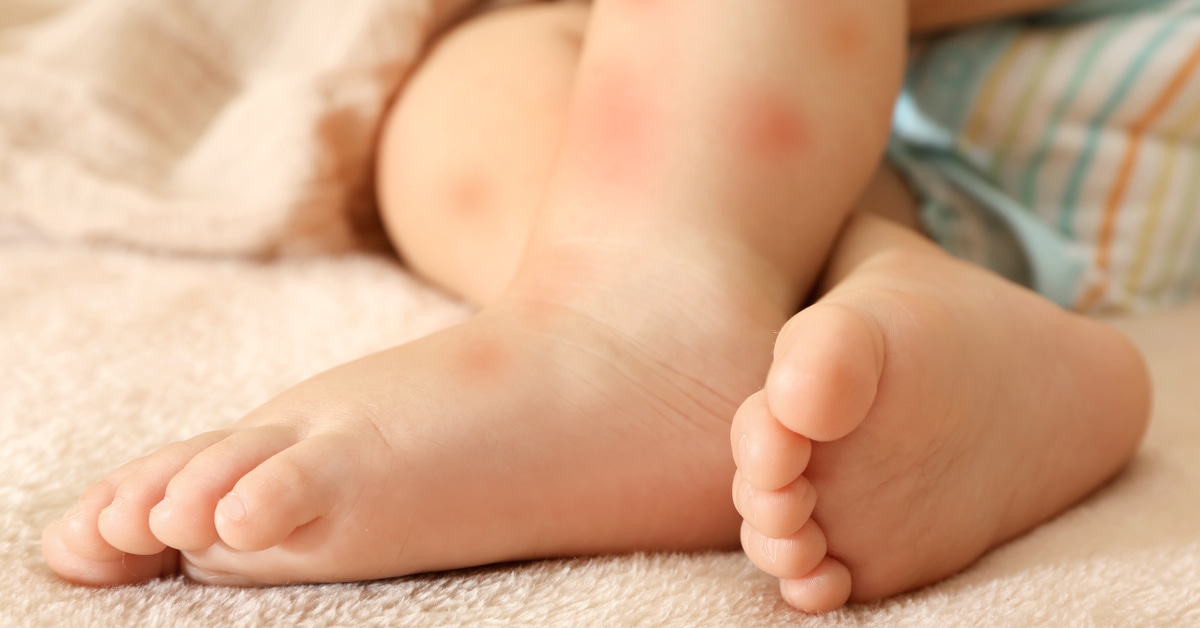 حساسية الجلد عند الأطفال كل ما تود معرفته ويب طب