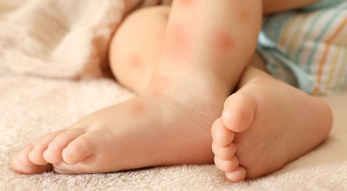 كل شيء عن حساسية الجلد عند الاطفال ويب طب