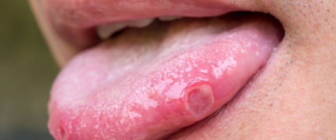 Cancer of the tongue: Here are all the facts! 