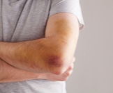 علاج الكدمات: خطوات أساسية ونصائح لشفاء سريع