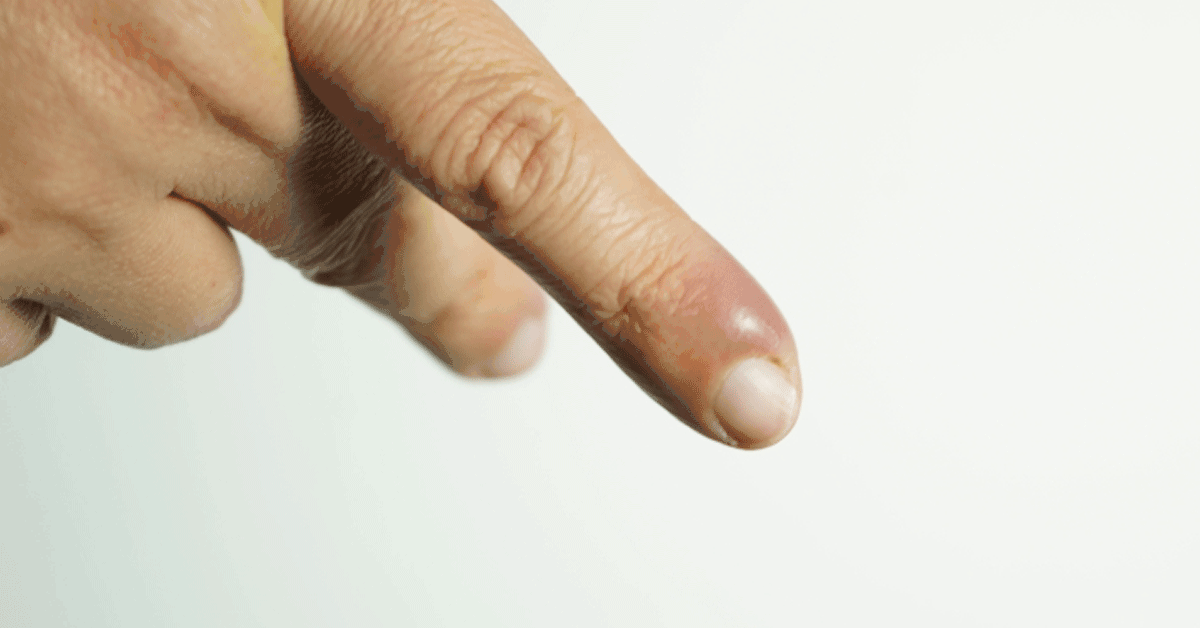 علاج الإصبع المدوحس ومعلومات هامة ويب طب