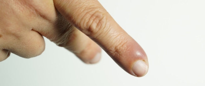 علاج الاصبع المدوحس ومعلومات هامة