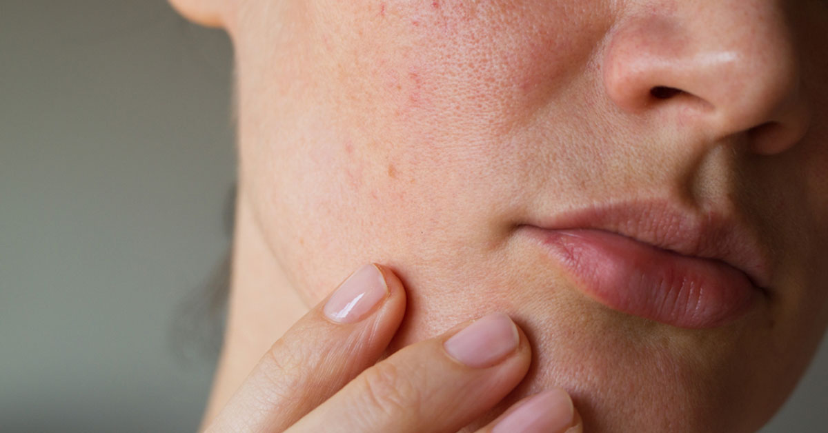 التهاب بشرة الوجه: الأسباب والعلاجات الطبيعية - ويب طب