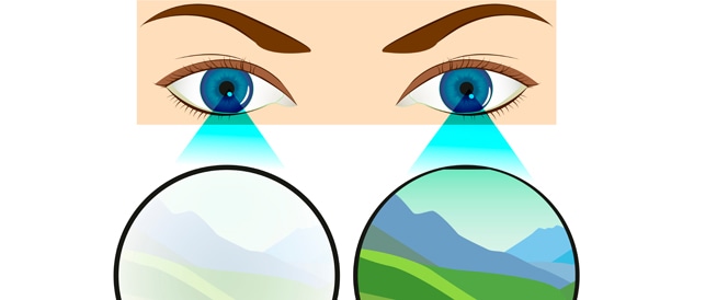 العين الكسولة الأسباب والأعراض وطرق العلاج ويب طب