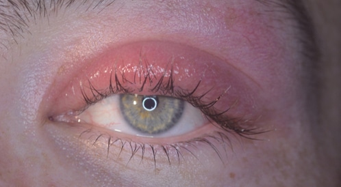 علاج تورم العين علاجات متنوعة تبعا للأسباب ويب طب
