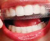 لصقات تبييض الأسنان: أهم الفوائد والمخاطر